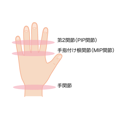 第2関節(PIP関節)・手指付け根関節(MIP関節)・手関節を表すイラスト