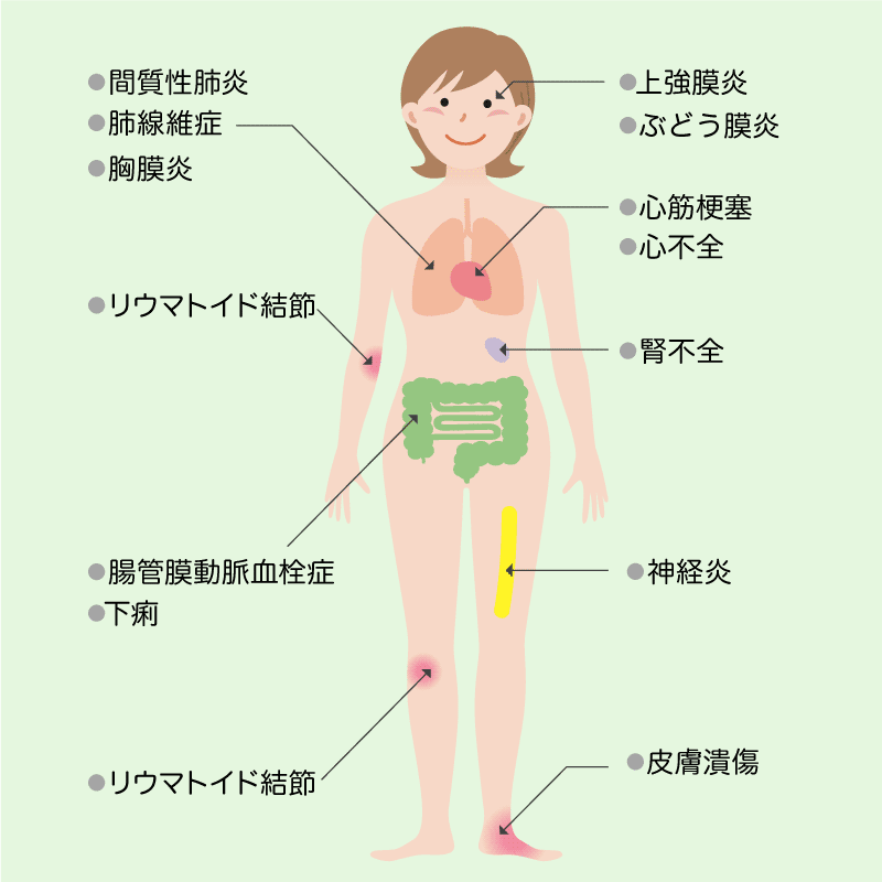 関節外症状の例のイラスト